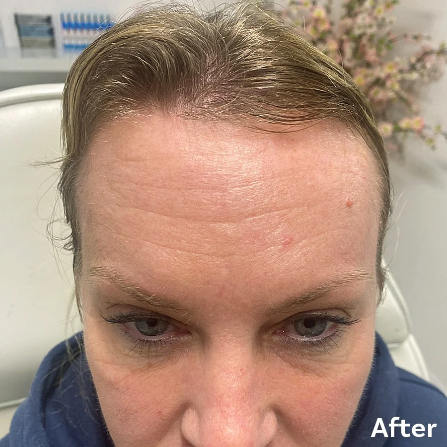 Botox After 1