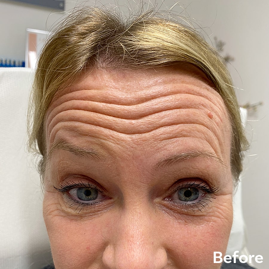 Botox Before 1