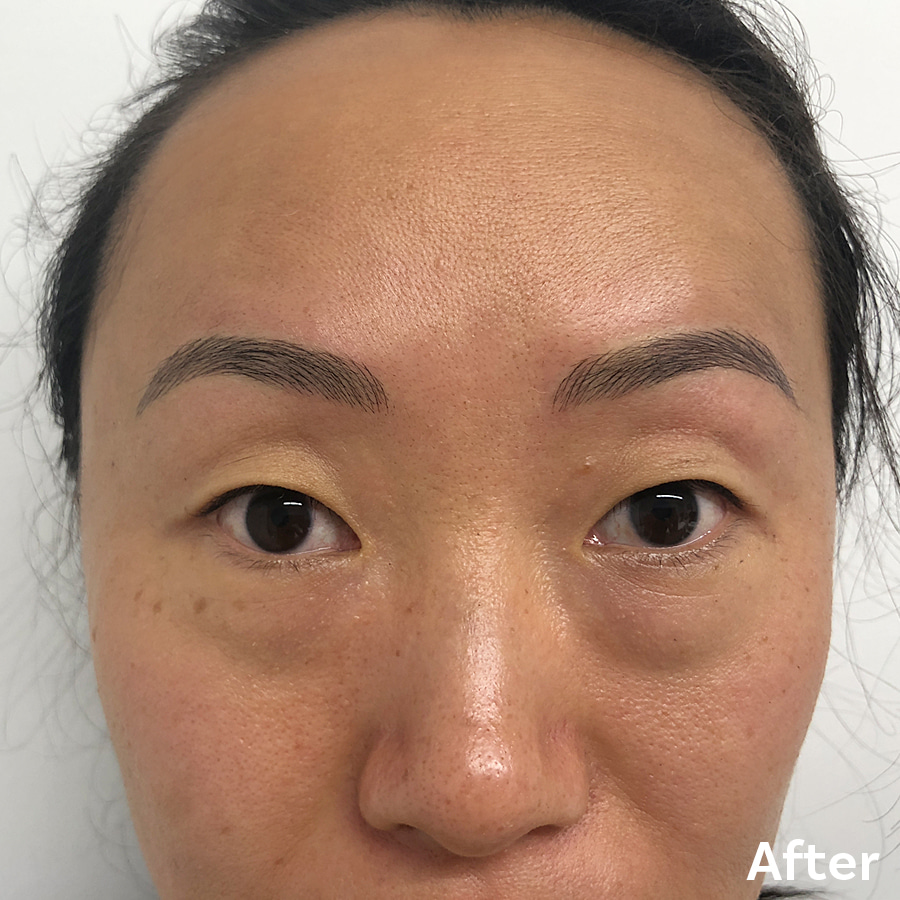 Microblading After 1